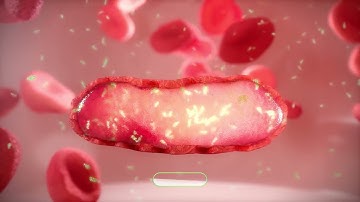 Encapsulated dexamethasone sodium phosphate (eDSP)