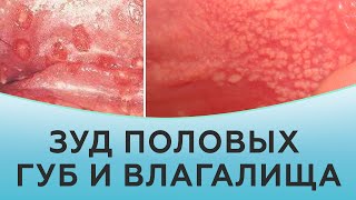 Воспалительные заболевания половых органов (вульвит, вагинит, вульвовагинит)