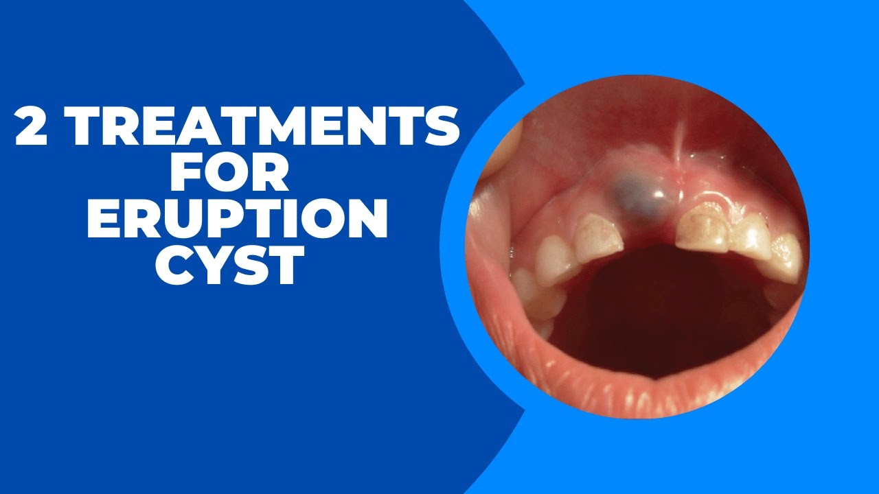 2 Treatments For Eruption Cyst Recommended By Dentists YouTube 2-treatments-for-eruption-cyst-recommended-by-dentists-youtube