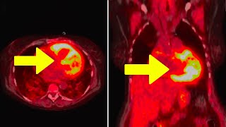 Young Man Takes Brand-New Vitamin K2 Supplement. This Happened To His Heart... screenshot 2