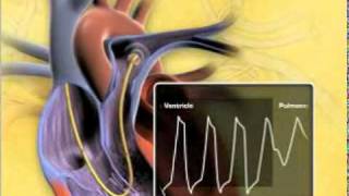 Swan Ganz Physiology
