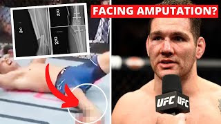 Dear @ChrisWeidmanMMA - Facing Amputation, From an Amputee