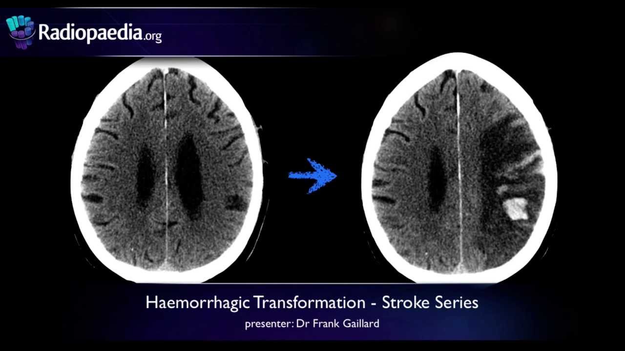 ischemic stroke vs hemorrhagic stroke