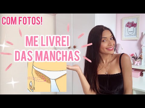 Vídeo: Como se livrar de manchas no rosto (com fotos)