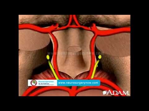 Pin Hole Surgery Hyderabad | Aneurysm Surgery India