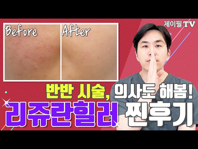 리쥬란힐러! 의사가 직접 맞아봤습니다