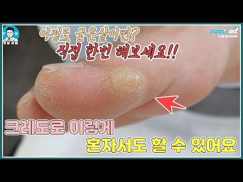 엄지 굳은살 크레도로 혼자서도 제거 할 수 있어요!  이 정도면 직접 굳은살 제거해보세요.  remove calluses [푸스올영등포당산점]