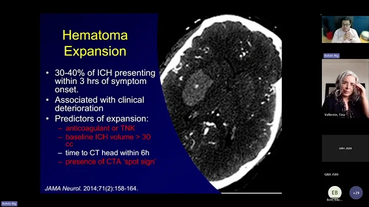 Stroke Series for Hospitalists 2025 - Managing ICH on the Unit (Dr. Ng)