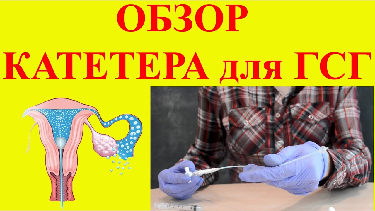 Обзор катетера для ГСГ (гистеросальпингографии) - YouTube