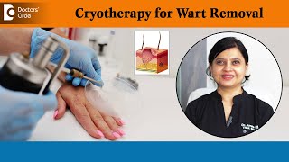 How to freeze and remove warts? | Wart Removal Using Cryotherapy - Dr. Amee Daxini | Doctors' Circle