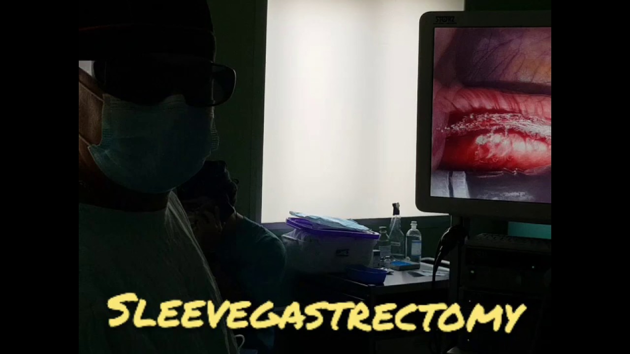 Бариатрическая операция- Резекция желудка для похудения. - YouTube