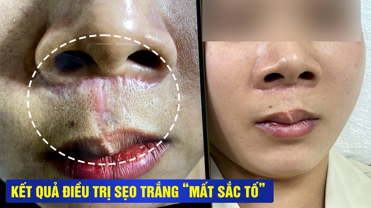 Ca điều trị sẹo trắng thành công, chỉ sau 1 buổi sẹo cải thiện tới 60 - 70% đồng đều mà da.