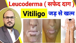 best homeopathic medicine for leucoderma/ vitiligo - सफेद दाग की होम्योपैथिक दवा / सफेद दाग की दवा,