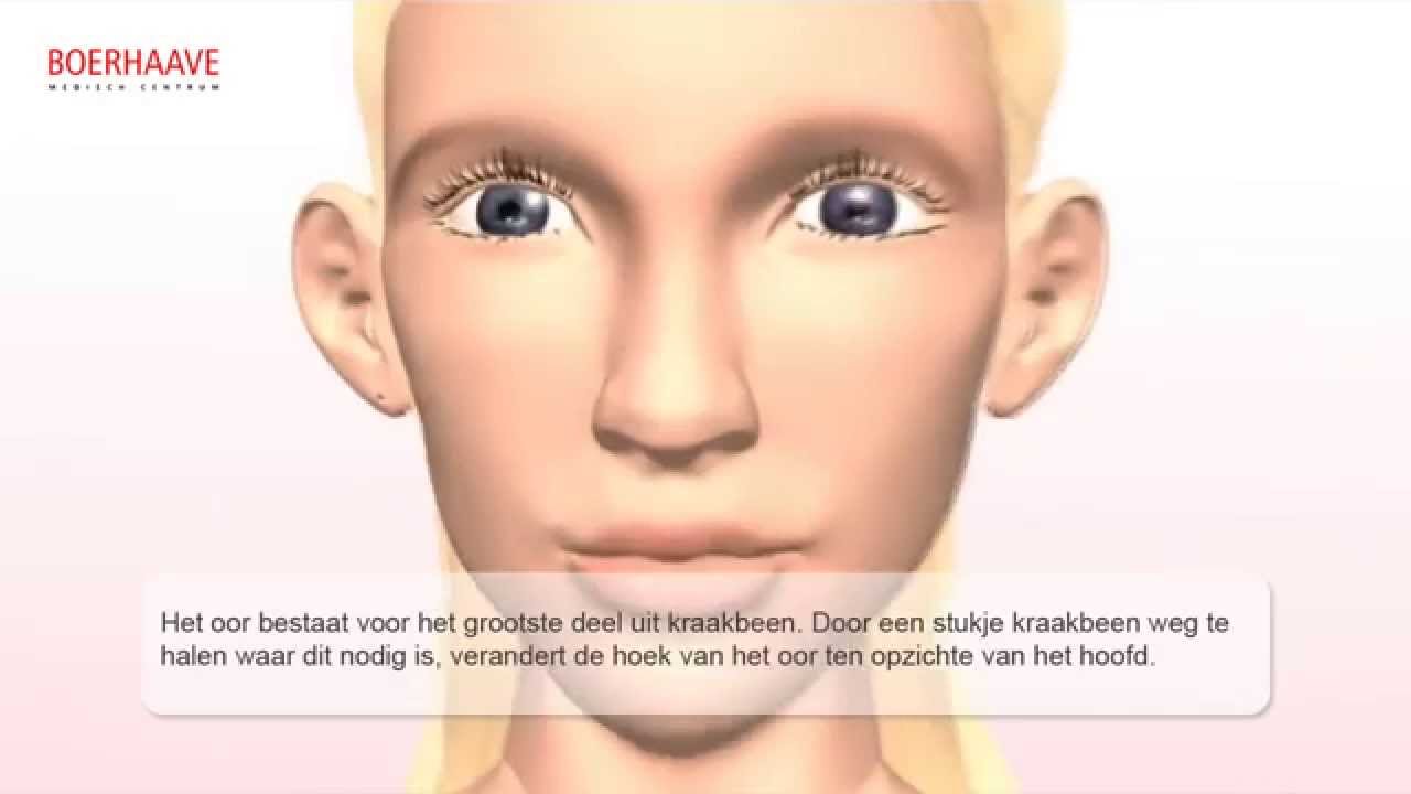 Video animatie van een oorcorrectie bij Dr Leo Peter van