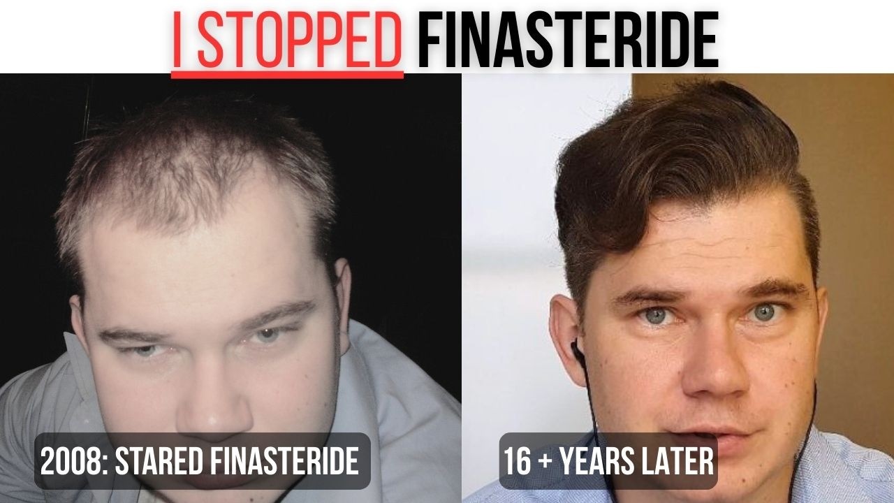 Вот как я прекратил принимать финастерид, не потеряв при этом волосы.