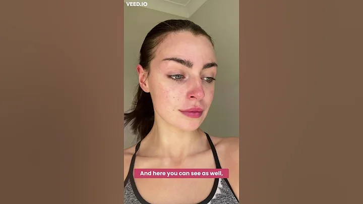Alisha's Skin Transformation In 28 Days