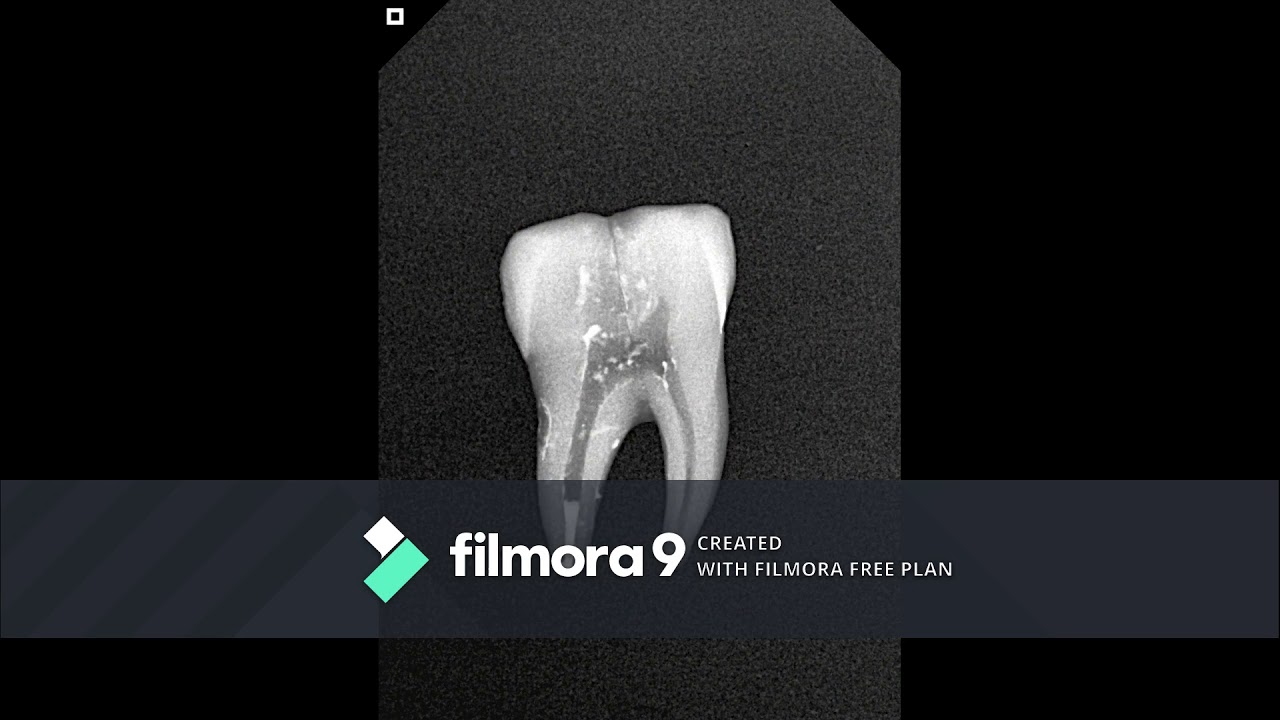 Técnica condensación vertical