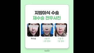 첫 시술은 물론, 재시술까지 - 인천 지방이식 잘하는 병원, 고센클리닉