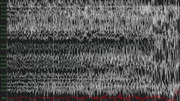 Interictal Discharges & GTC Seizure