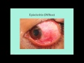 Scleritis - CRASH! Medical Review Series