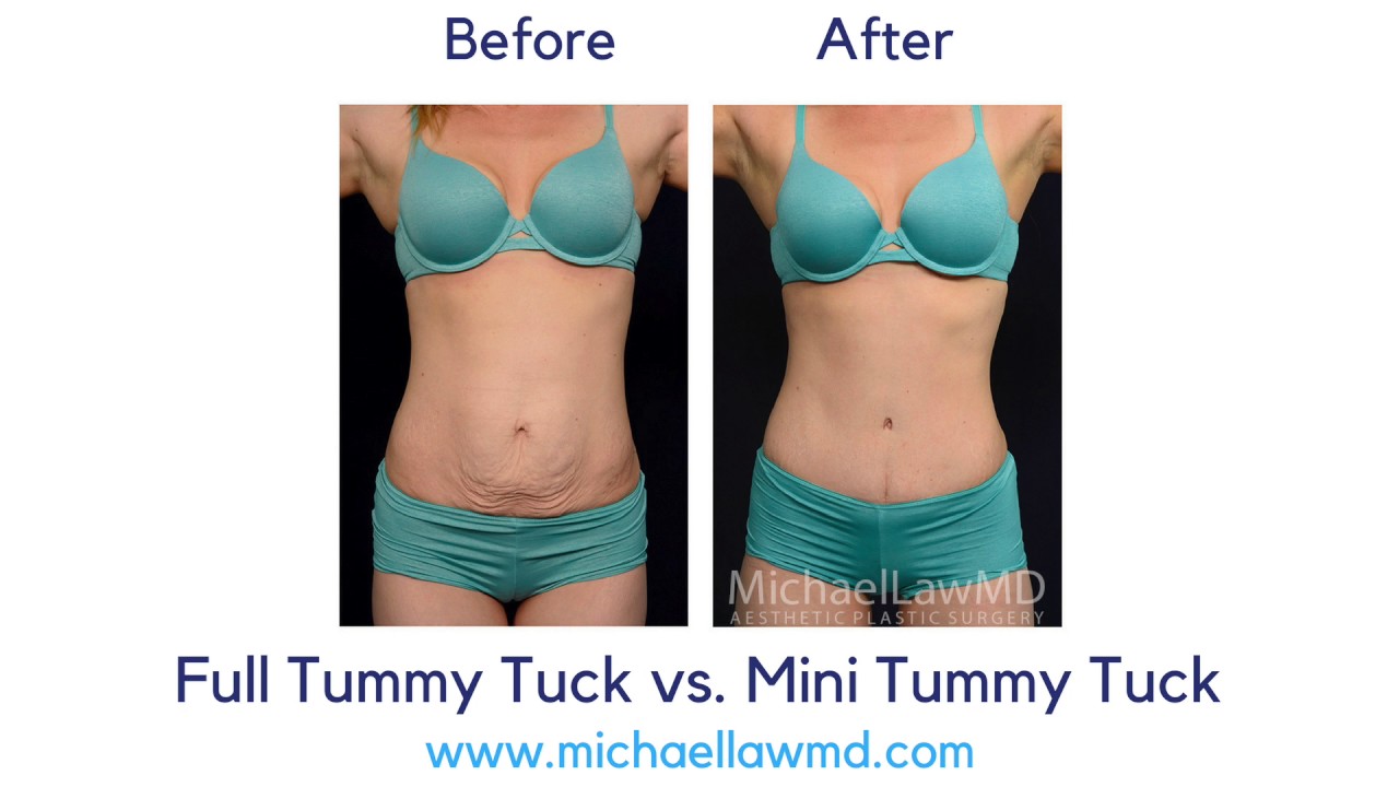 Photos tuck mini tummy Photos tuck mini tummy
