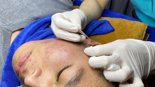 Acne Treatment For "Hung" (P13) | Điều Trị Mụn Cho Hùng (P13) - SacDepSpa#211