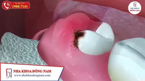 [TÌM HIỂU] Tác Hại Của Việc Mọc Răng Khôn | NHA KHOA ĐÔNG NAM®