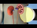 Lithotripsy Trailer | Biomedical Engineers TV |