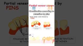classification according to retention by pins#dental#prosthodontics #dentistry #dentalcrowns#dentist