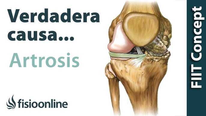 Artrosis. Síntomas, diagnóstico y tratamiento. Clínica U. Navarra