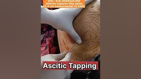 How to Do ASCITIC TAPPING | PARACENTESIS | Procedure #shorts #medical #doctor