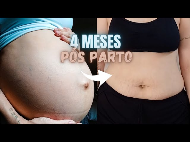 Barriga 4 meses pós parto cesárea
