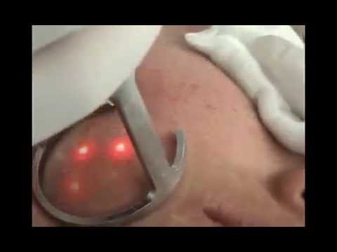 Laser skin resurfacing for acne scars removal treatment with fractional CO laser