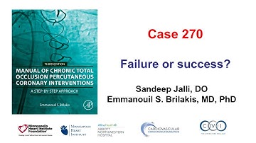 Case 270: Manual of CTO PCI - Success or failure?