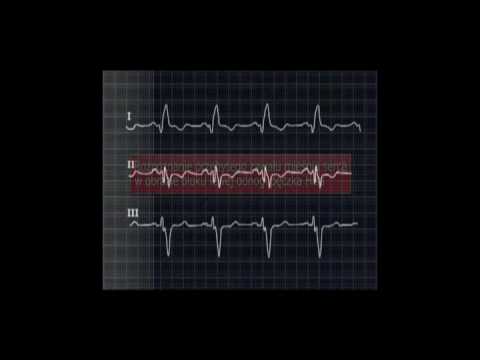 EKG blok lewej odnogi pęczka Hisa