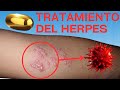 Tratamiento del herpes