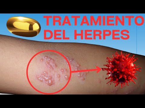 Video: Cómo curar rápidamente un brote de herpes: 10 pasos (con imágenes)