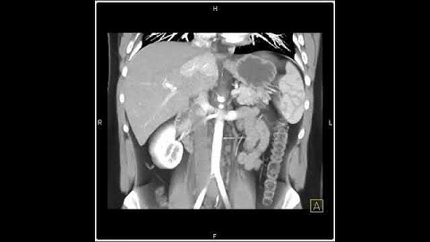 Abdomen: Liver: A series of axial and 3D views show a mass in the left lobe of the liver(1 of 2)