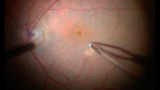 Retinal Surgery: Internal limiting membrane (ILM) peel in Macular hole surgery