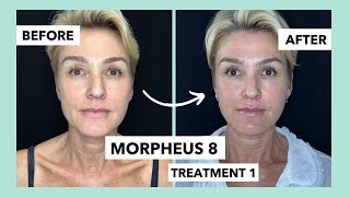Morpheus 8 Treatment // Non Surgical Facelift // Before and After Treatment 1