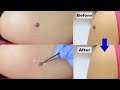 I got my mole removed in 5 minutes | Everything you need to know about getting moles removed