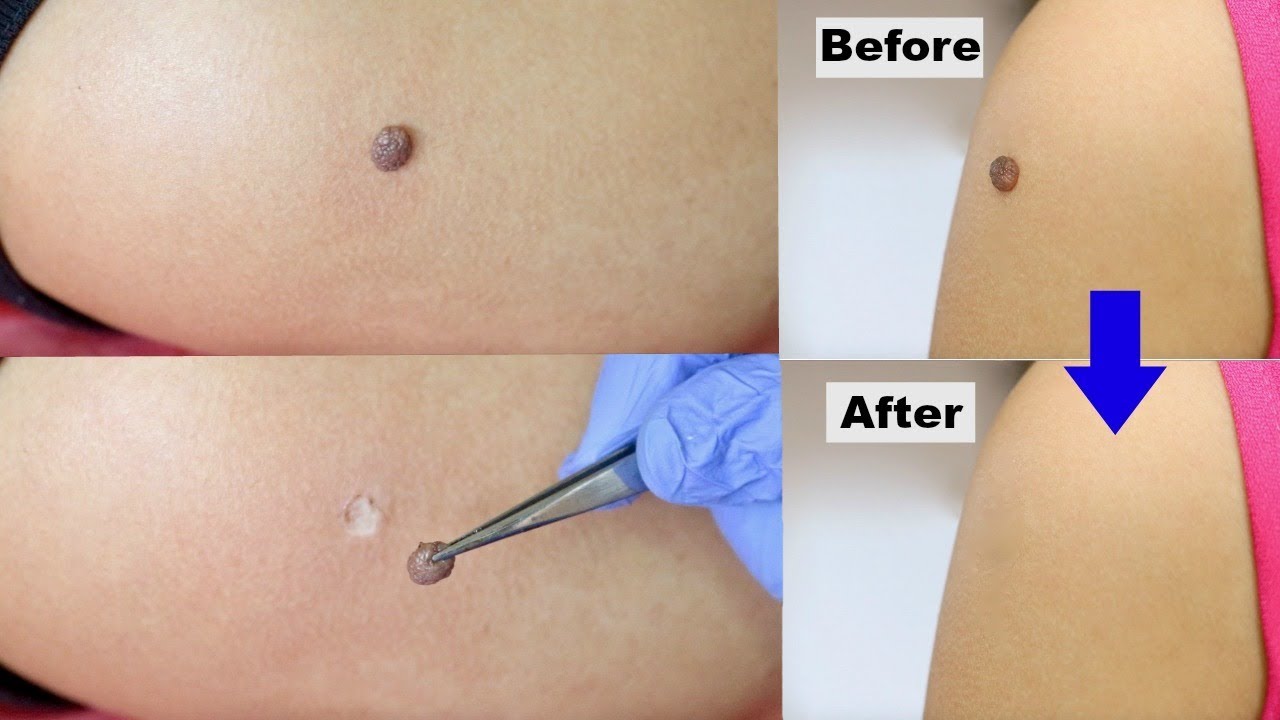 3 Mole Removal You Should Never Make