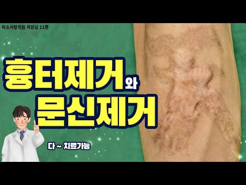 (*Eng)Burn scar and tatoo removal just laser treatment