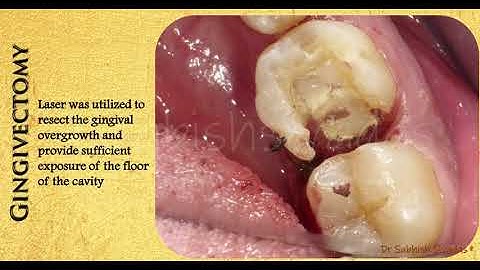 Deep Marginal Elevation