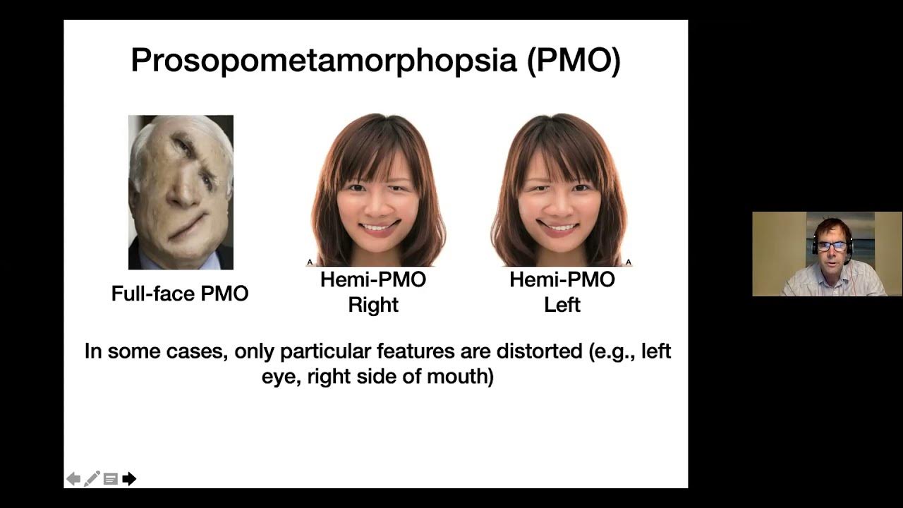 Prof Brad Duchaine on "Prosopometamorphopsia Face distortions as a