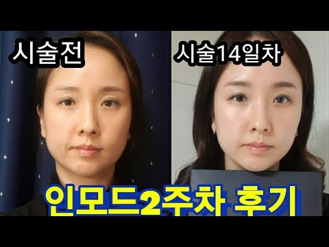 강남역 피부과에서 인모드 내 금내산 후기 7