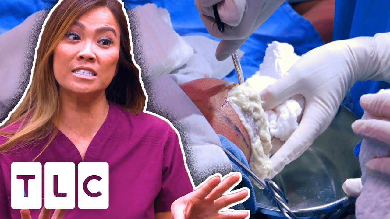 Download Dr.Lee Pops The BIGGEST CYST She Has Ever Seen! | Dr. Pimple Popper | UNCENSORED | 18+