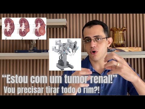 Vídeo: Como prevenir o câncer renal: 12 etapas (com fotos)