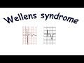 Wellens syndrome