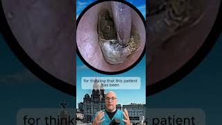 IMPACTED Ear Wax! Full video in link below